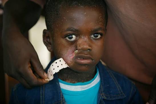 WHO unveils new plan to tackle noma, a devastating disease affecting vulnerable children in Africa