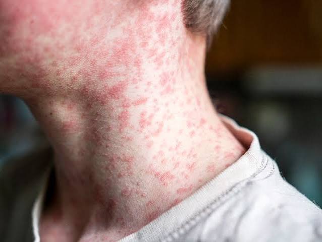 Kentucky Confirms First Measles Case Since January; Officials Suspect More